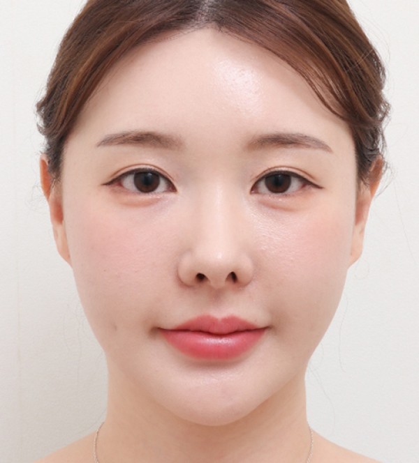 中年面部吸脂