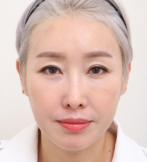 中年面部吸脂