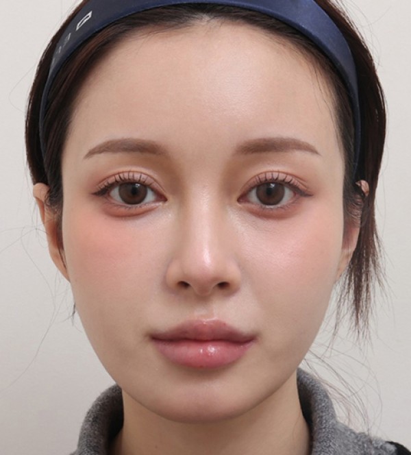 面部脂肪移植