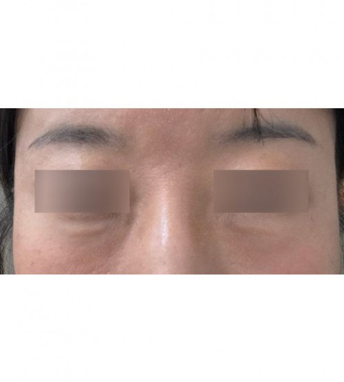 眼下結節去除