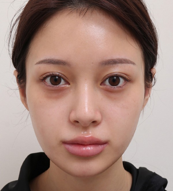 面部脂肪移植
