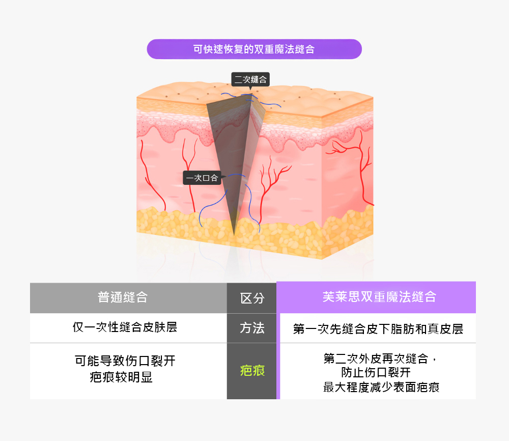 腹部提升术