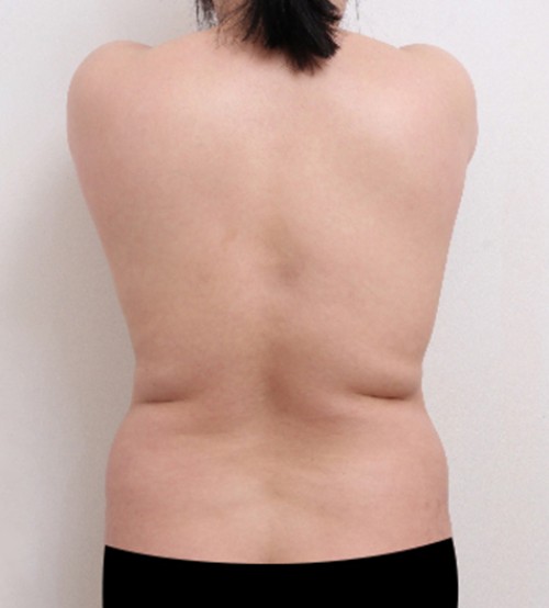 威塑2 身体吸脂