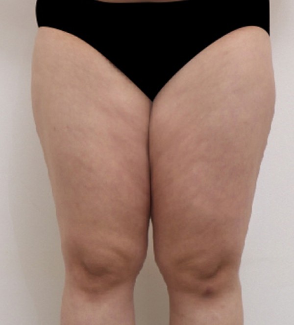 威塑2 身体吸脂