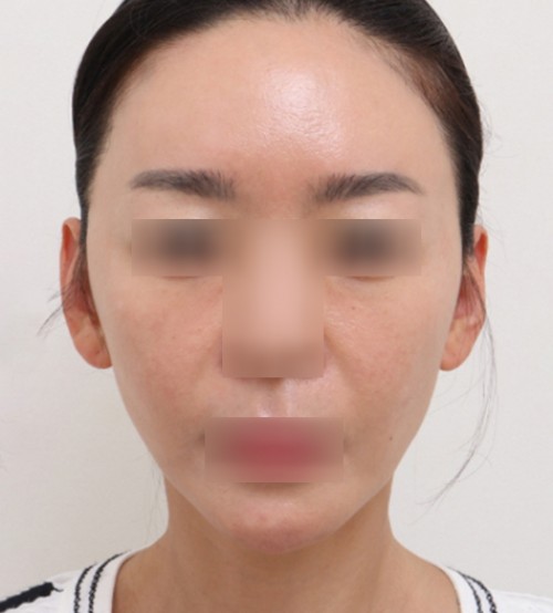 面部脂肪移植