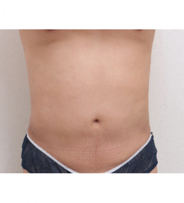 威塑2 身体吸脂