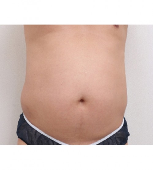 威塑2 身体吸脂