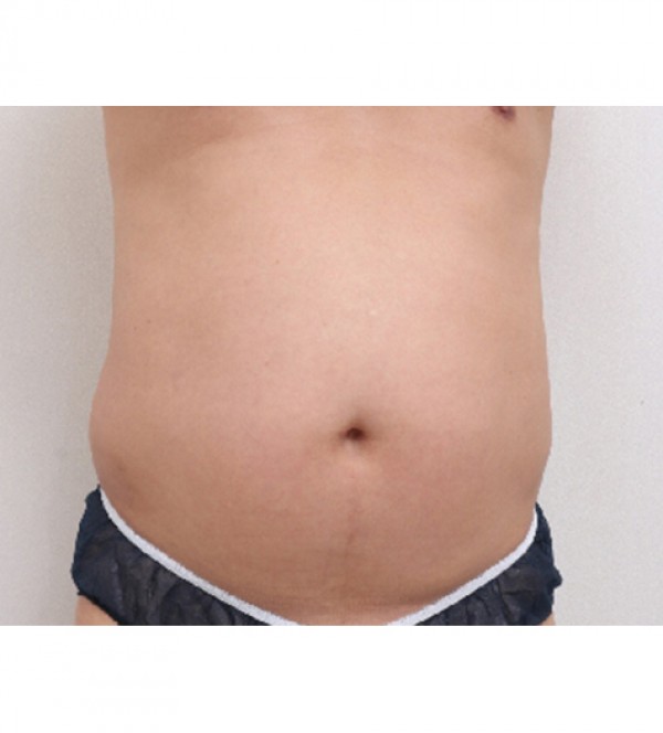 威塑2 身体吸脂