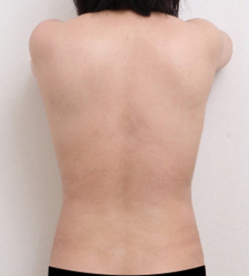 威塑2 身体吸脂