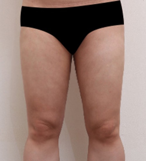 威塑2 身体吸脂