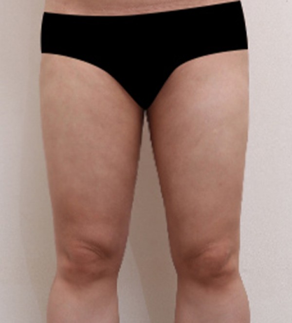 威塑2 身体吸脂